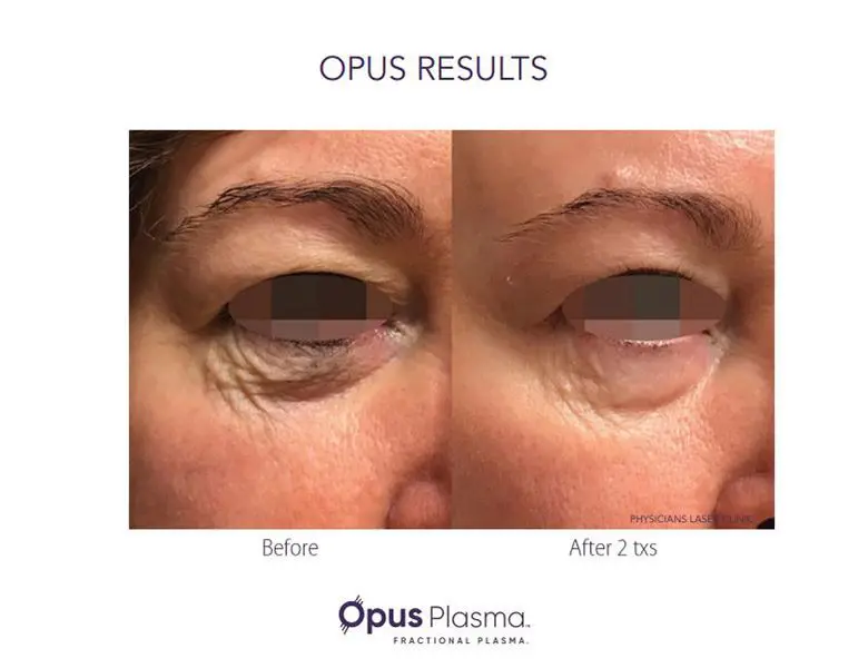 A before and after picture of an individual 's eye.