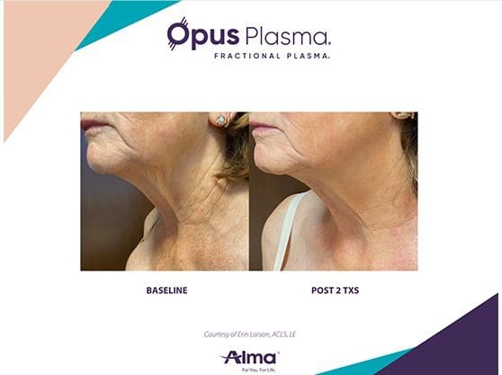 A before and after picture of an older woman 's neck.