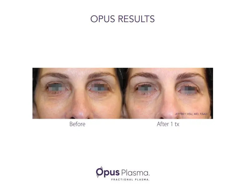 A woman 's eyes before and after using the opus plasma system.