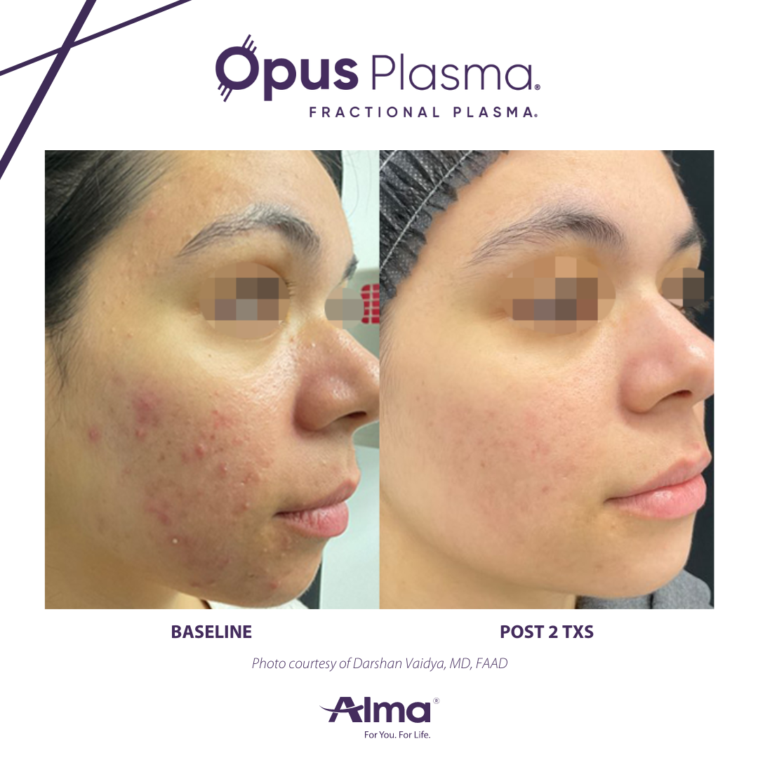 A before and after photo of a woman 's face with the results of plasma treatment.