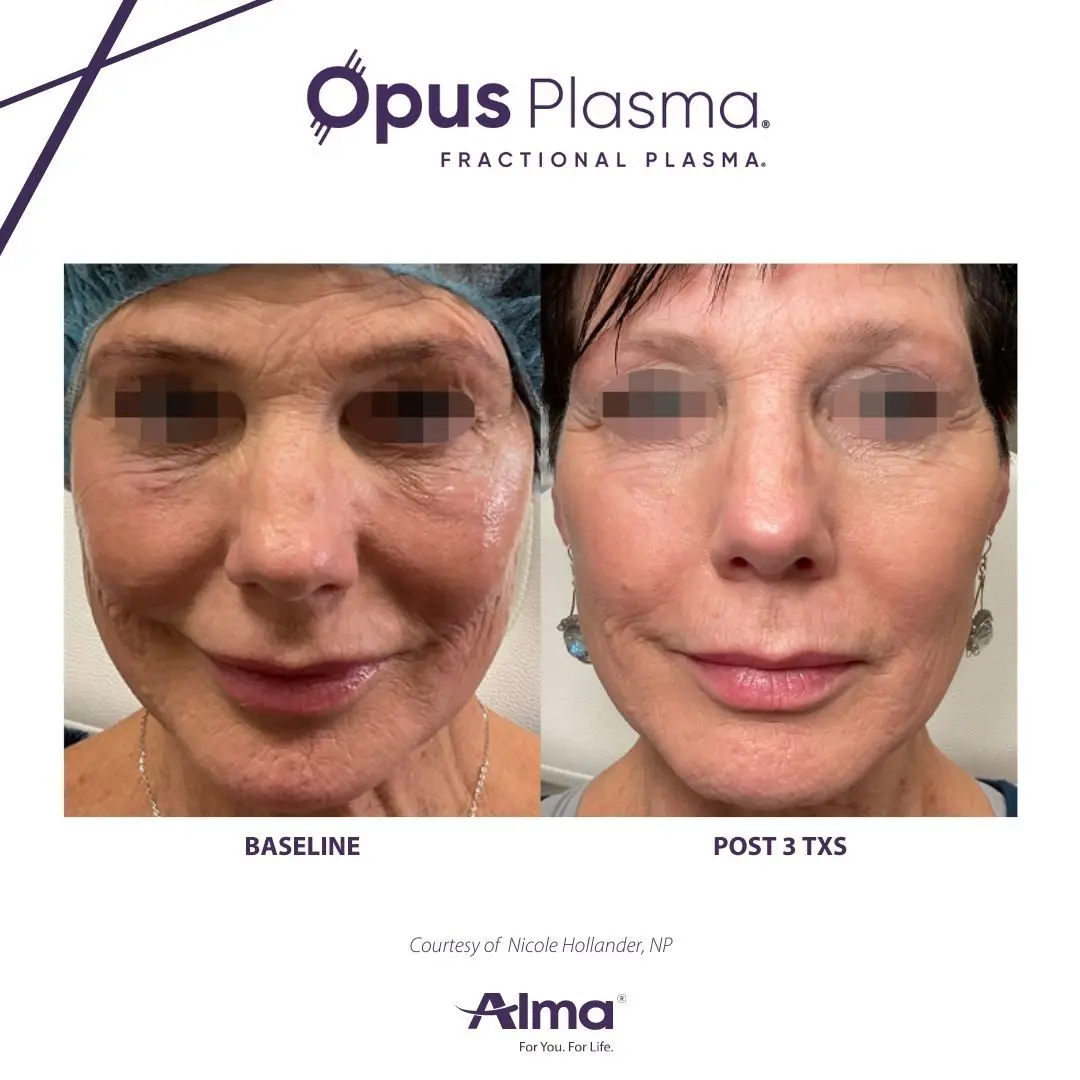 A before and after picture of an older woman 's face.