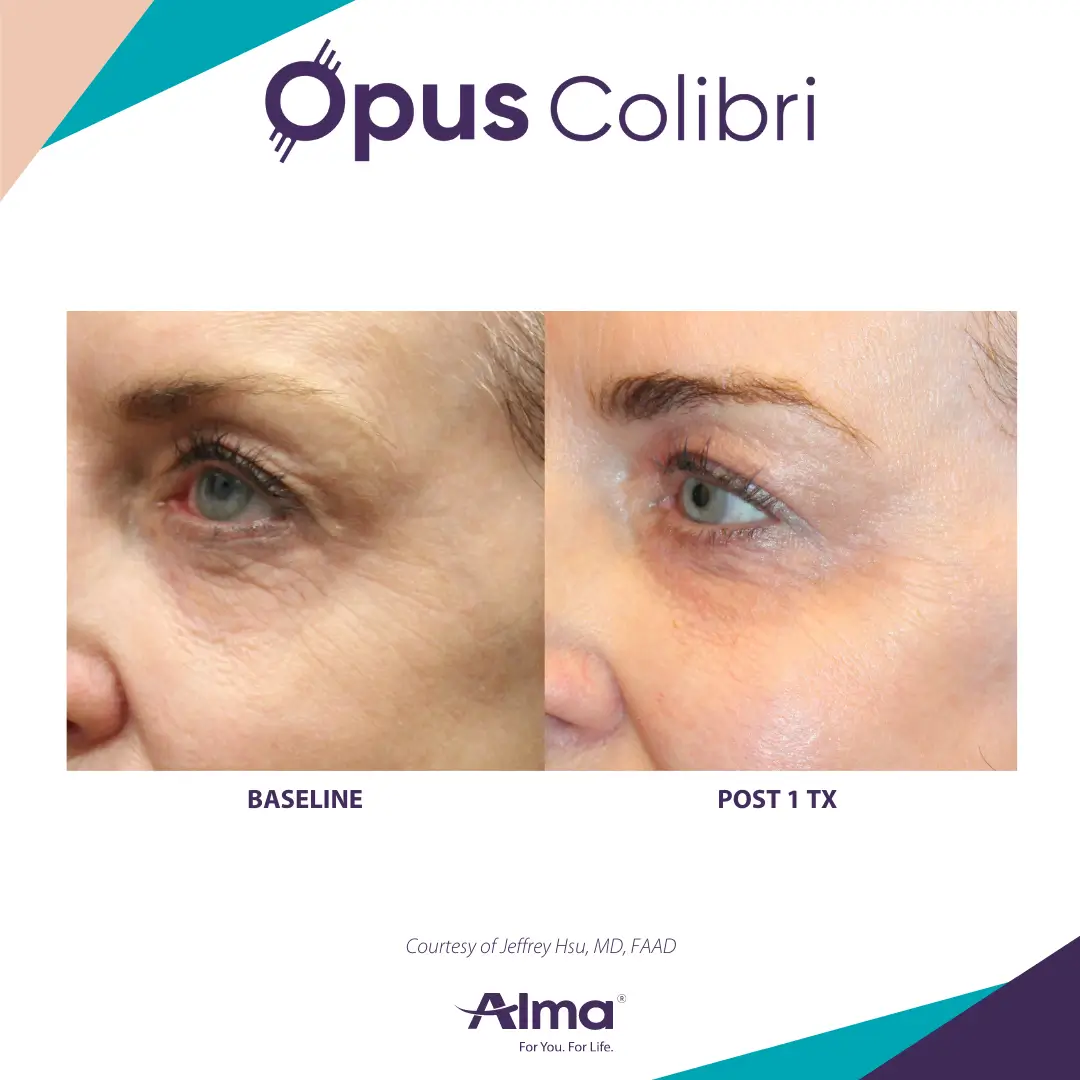 A woman 's face before and after using the alma opus treatment.